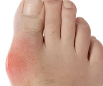 Крем від «кісточки» на великому пальці