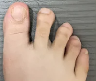 Крем від «кісточки» на великому пальці